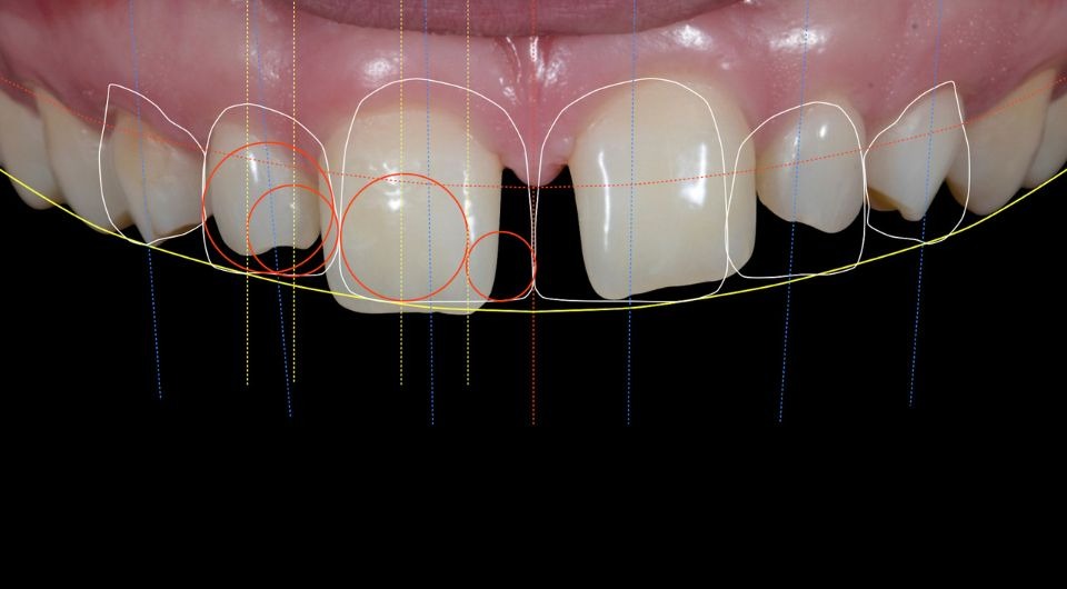 5 Facts on Digital Smile Design