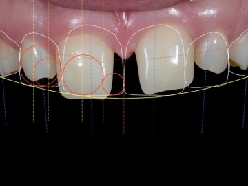 5 Facts on Digital Smile Design