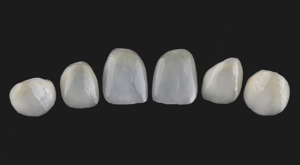 Types of Veneers and Costs