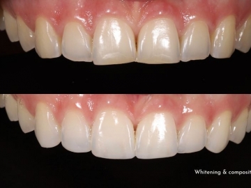 What's the Difference Between Composite Bonding and Veneers