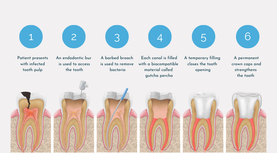 Debunking Myths About Root Canal Therapy: Facts and Misconceptions