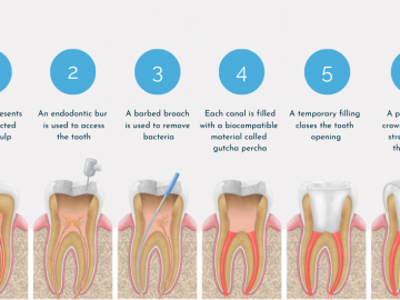 Debunking Myths About Root Canal Therapy: Facts and Misconceptions