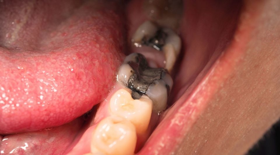 Amalgam Dental Fillings: Are They Cause for Concern