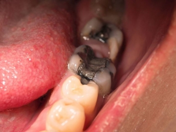 Amalgam Dental Fillings: Are They Cause for Concern