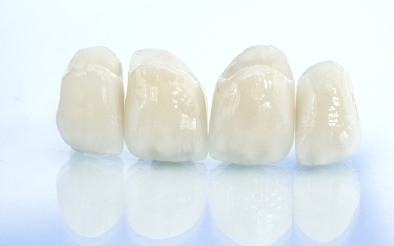 Dental Crowns: Costs and Longevity