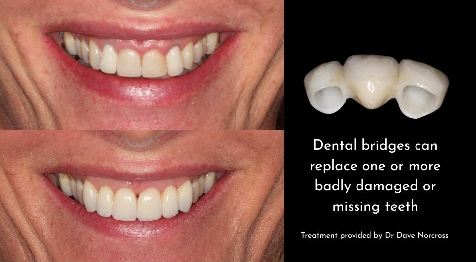 Bridges: A Cost-Effective Solution for Missing Teeth