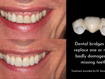 Bridges: A Cost-Effective Solution for Missing Teeth