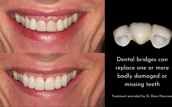 Bridges: A Cost-Effective Solution for Missing Teeth