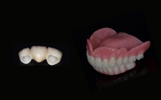 Bridges or Dentures: What’s Right for You