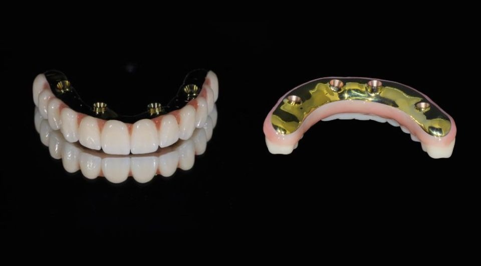 How Long Do All-On-4® Dental Implants Last in Australia