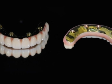 How Long Do All-On-4® Dental Implants Last in Australia
