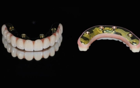 How Long Do All-On-4® Dental Implants Last in Australia