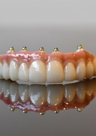 Dental Implants