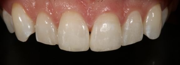 Composite Bonding