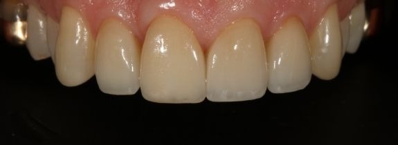 Veneers, Crowns and Bonding