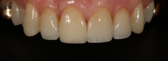Veneers, Crowns and Bonding