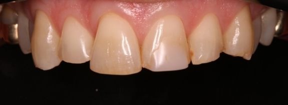 Veneers, Crowns and Bonding