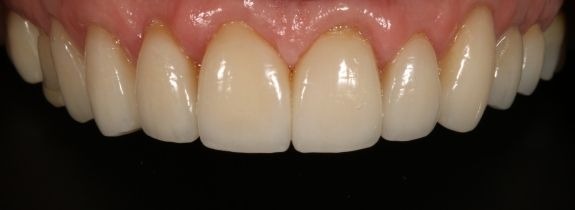 Crowns, Whitening