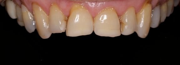 Crowns, Whitening