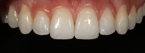Invisalign®, Whitening, Bonding