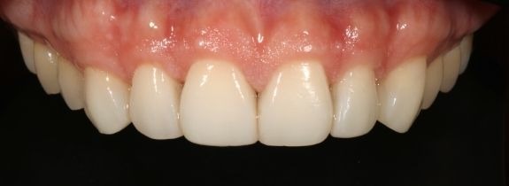 Composite Veneers