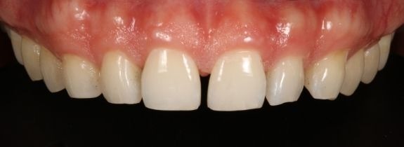 Composite Veneers
