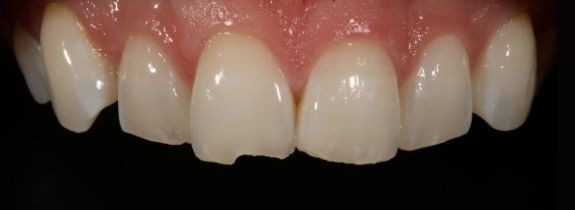 Composite Bonding