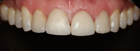 Porcelain Veneers, Crown Lengthening (by Dr Norcross) & Whitening