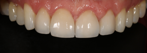 Porcelain Veneers, Crown Lengthening (by Dr Norcross) & Whitening