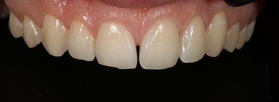 Invisalign®, Whitening, Bonding  (3 teeth) Gum Lift