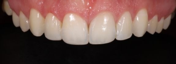 Invisalign®, Whitening, Bonding  (3 teeth) Gum Lift