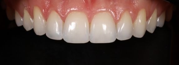 Invisalign® (top arch), Whitening, Bonding (1 tooth) and Recontouring