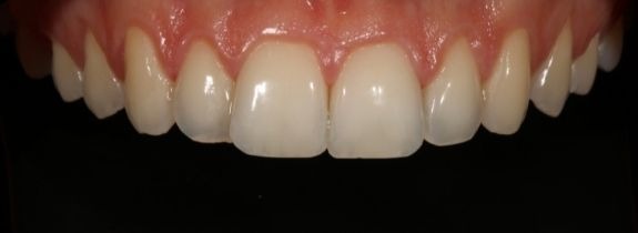 Invisalign® (top arch), Whitening, Bonding (1 tooth) and Recontouring