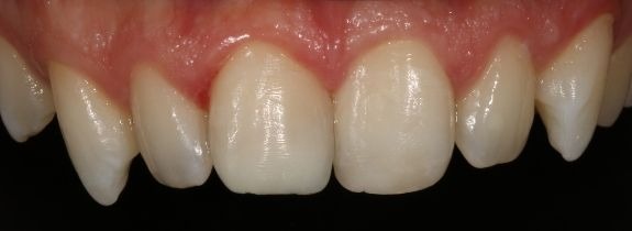 Bonding & Whitening (replaced old composite central upper tooth)