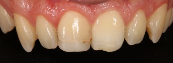Bonding & Whitening (replaced old composite central upper tooth)