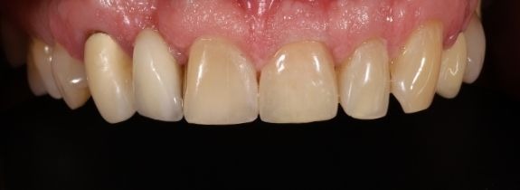 Crown and composite repair of bridge