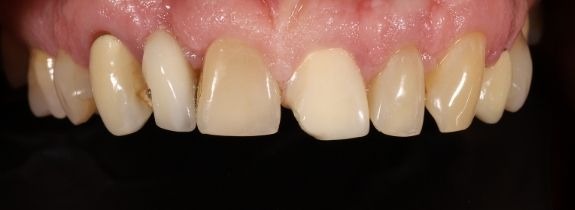 Crown and composite repair of bridge