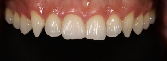Crown and Teeth Whitening