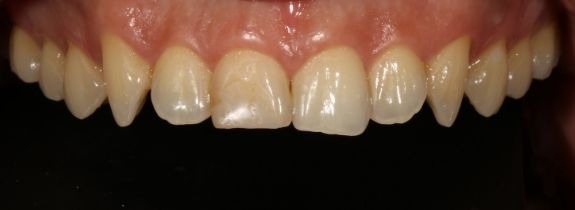 Crown and Teeth Whitening