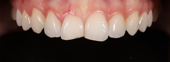 Bonding, Whitening and Gum lift