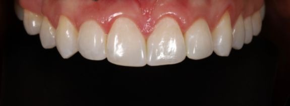 Invisalign®, Whitening, Bonding