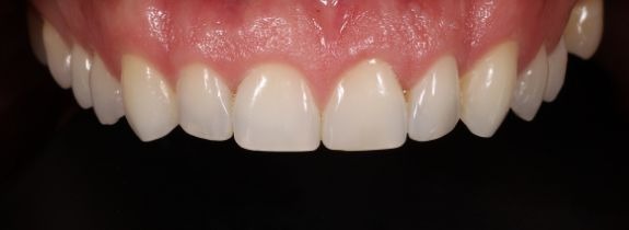 Invisalign®, Whitening, Bonding