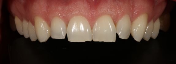 Invisalign®, Whitening, Bonding