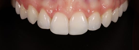 Bonding, Whitening and Gum lift