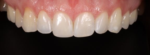 Whitening and Bonding