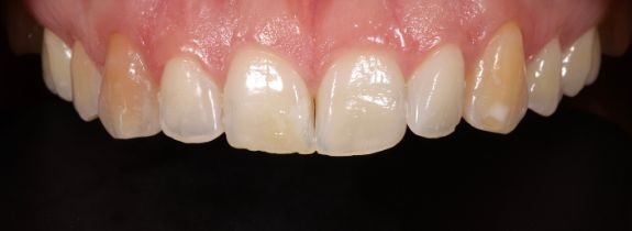 Whitening and Bonding