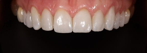 Porcelain Veneers, Crowns, Whitening & Bonding