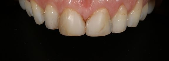 Porcelain Veneers, Crowns, Whitening & Bonding