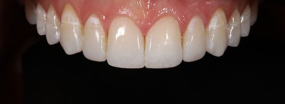 Composite Veneers & Whitening