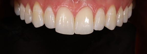 Composite Veneers & Whitening